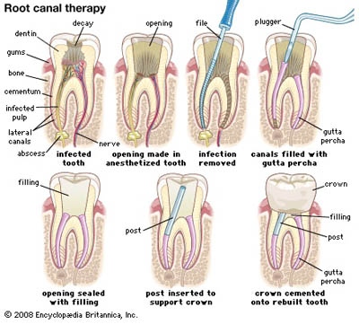 Root canal treatment steps, including opening the tooth, removing the infection, adding a post, filling the tooth, and covering it with a crown
